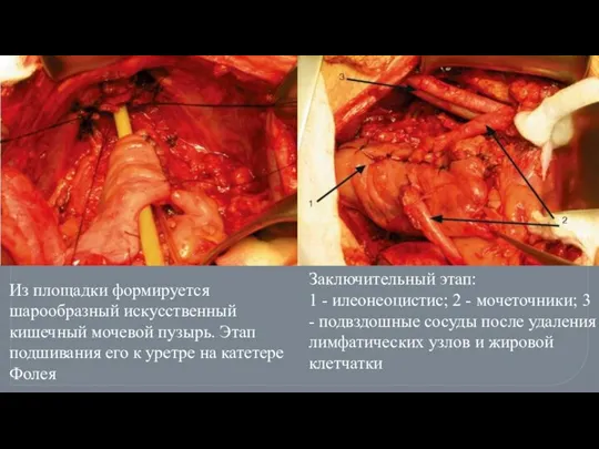 Из площадки формируется шарообразный искусственный кишечный мочевой пузырь. Этап подшивания его