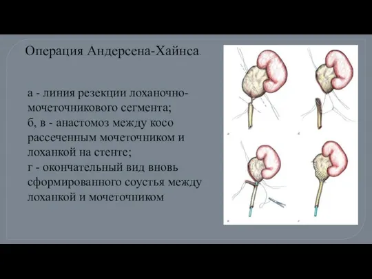 Операция Андерсена-Хайнса. а - линия резекции лоханочно-мочеточникового сегмента; б, в -