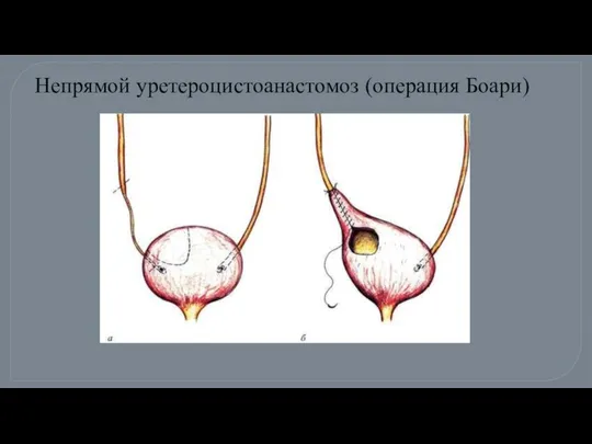 Непрямой уретероцистоанастомоз (операция Боари)