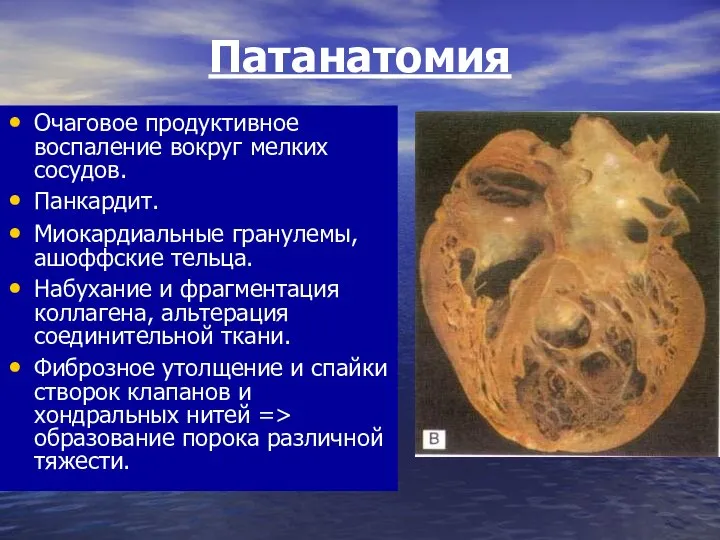 Патанатомия Очаговое продуктивное воспаление вокруг мелких сосудов. Панкардит. Миокардиальные гранулемы, ашоффские