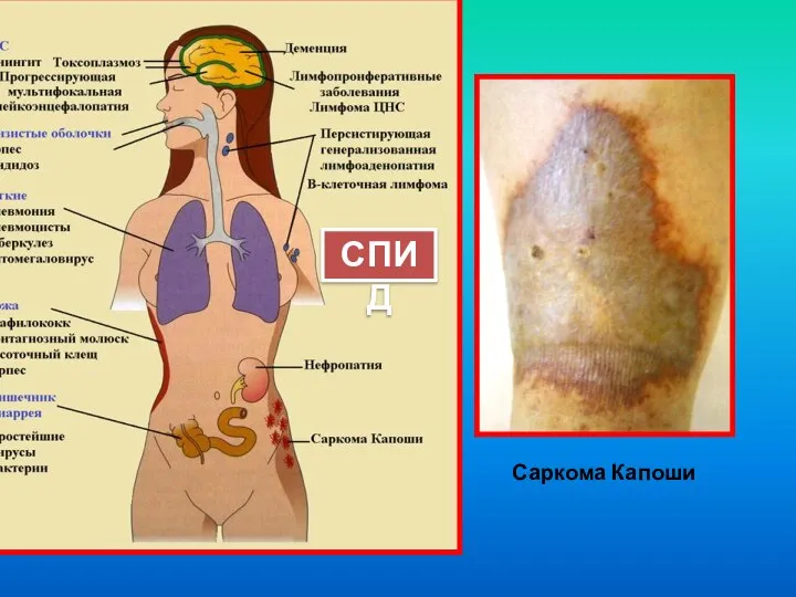 СПИД Саркома Капоши