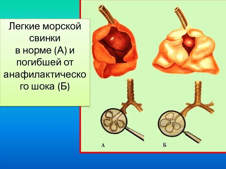 Легкие морской свинки в норме (А) и погибшей от анафилактического шока (Б)