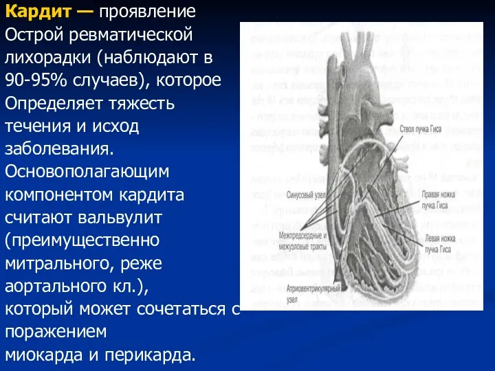 Кардит — проявление Острой ревматической лихорадки (наблюдают в 90-95% случаев), которое