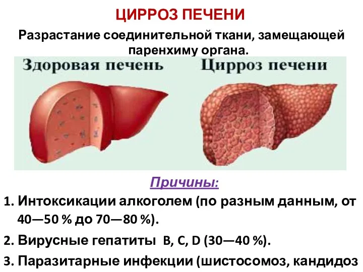 ЦИРРОЗ ПЕЧЕНИ Разрастание соединительной ткани, замещающей паренхиму органа. Причины: 1. Интоксикации