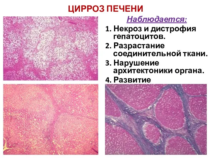 ЦИРРОЗ ПЕЧЕНИ Наблюдается: 1. Некроз и дистрофия гепатоцитов. 2. Разрастание соединительной