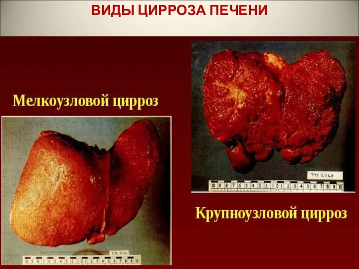 ВИДЫ ЦИРРОЗА ПЕЧЕНИ