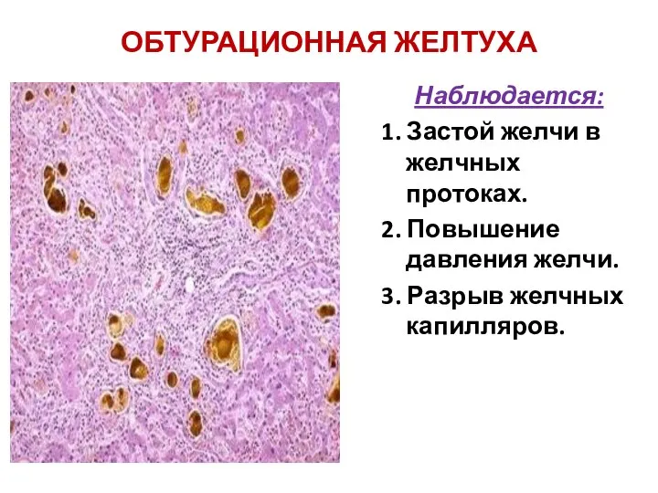 ОБТУРАЦИОННАЯ ЖЕЛТУХА Наблюдается: 1. Застой желчи в желчных протоках. 2. Повышение