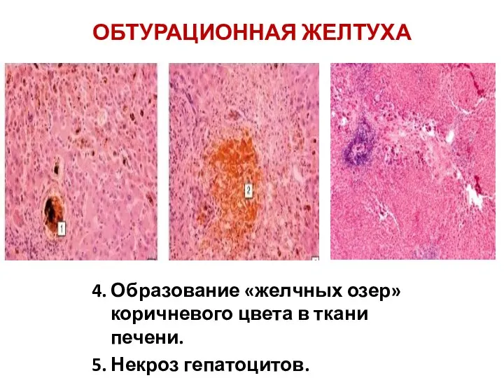 ОБТУРАЦИОННАЯ ЖЕЛТУХА 4. Образование «желчных озер» коричневого цвета в ткани печени. 5. Некроз гепатоцитов.