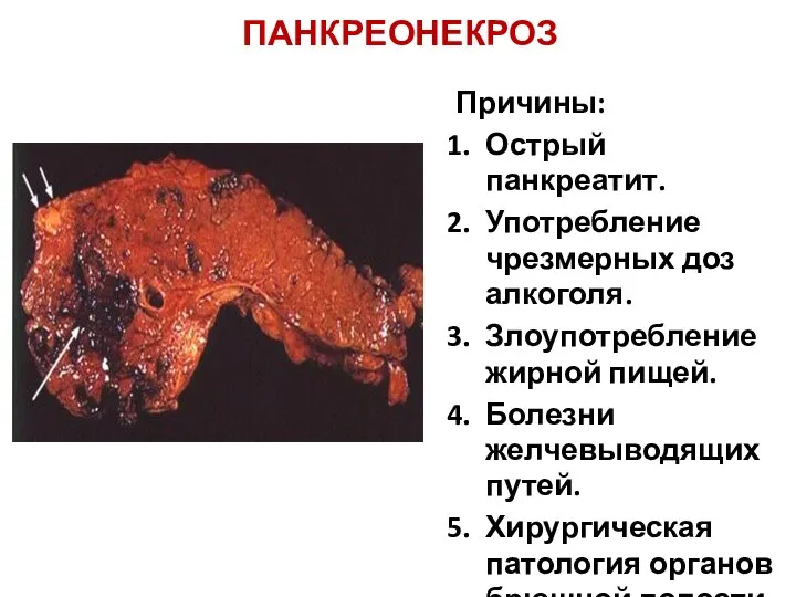 ПАНКРЕОНЕКРОЗ Причины: Острый панкреатит. Употребление чрезмерных доз алкоголя. Злоупотребление жирной пищей.