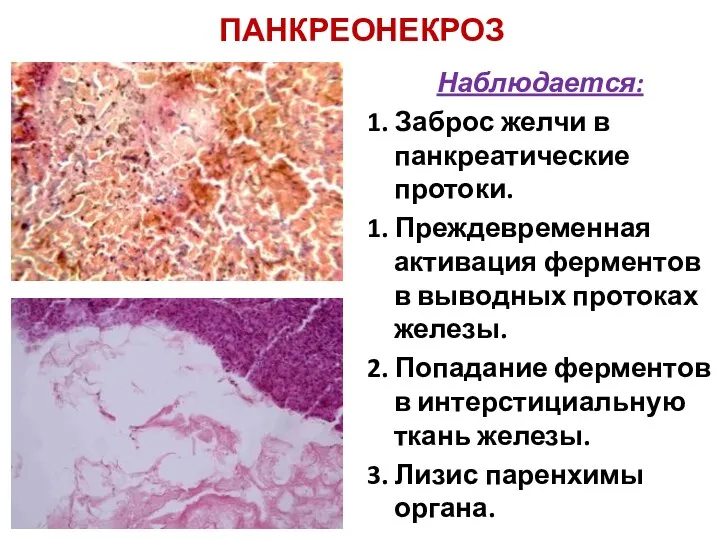 ПАНКРЕОНЕКРОЗ Наблюдается: 1. Заброс желчи в панкреатические протоки. 1. Преждевременная активация