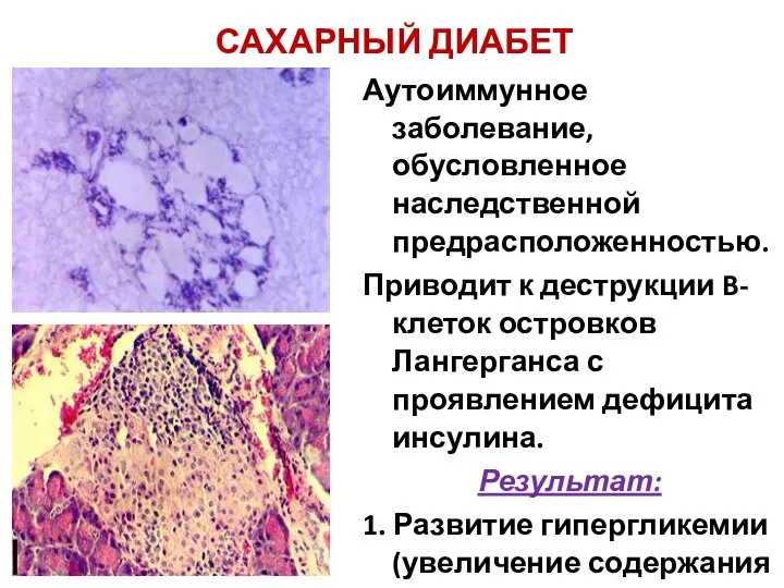 САХАРНЫЙ ДИАБЕТ Аутоиммунное заболевание, обусловленное наследственной предрасположенностью. Приводит к деструкции B-клеток