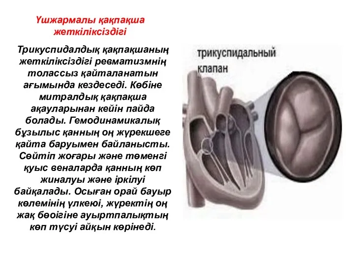 Үшжармалы қақпақша жеткіліксіздігі Трикуспидалдық қақпақшаның жеткіліксіздігі ревматизмнің толассыз қайталанатын ағымында кездеседі.