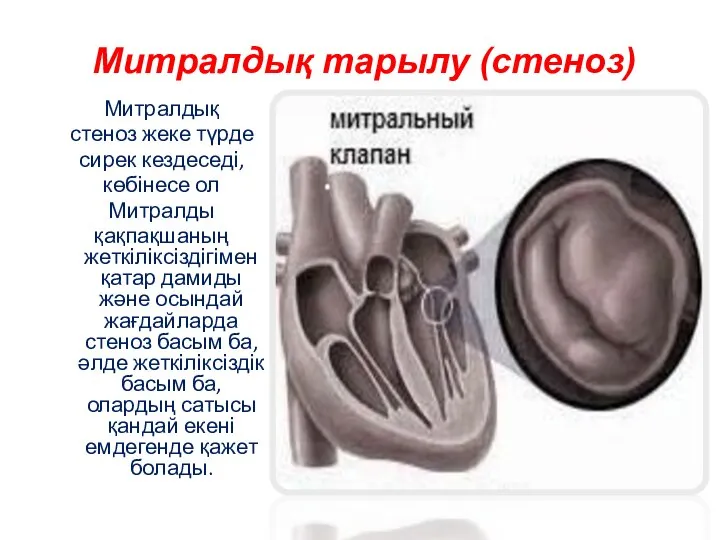 Митралдық тарылу (стеноз) Митралдық стеноз жеке түрде сирек кездеседі, көбінесе ол