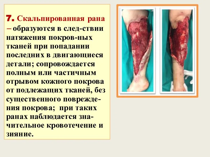 7. Скальпированная рана – образуются в след-ствии натяжения покров-ных тканей при