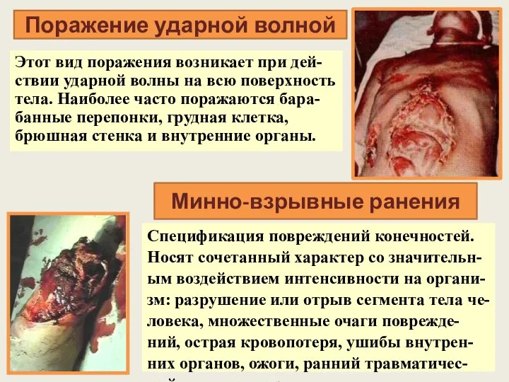 Поражение ударной волной Этот вид поражения возникает при дей-ствии ударной волны