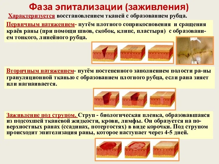 Характеризуется восстановлением тканей с образованием рубца. Фаза эпитализации (заживления) Вторичным натяжением-