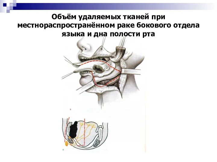Объём удаляемых тканей при местнораспространённом раке бокового отдела языка и дна полости рта