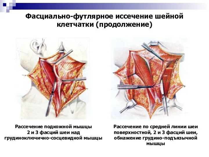 Фасциально-футлярное иссечение шейной клетчатки (продолжение) Рассечение подкожной мышцы 2 и 3