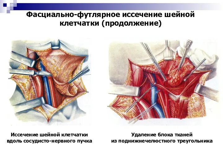 Фасциально-футлярное иссечение шейной клетчатки (продолжение) Иссечение шейной клетчатки вдоль сосудисто-нервного пучка