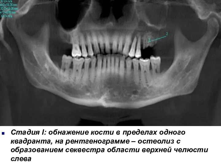 Стадия I: обнажение кости в пределах одного квадранта, на рентгенограмме –