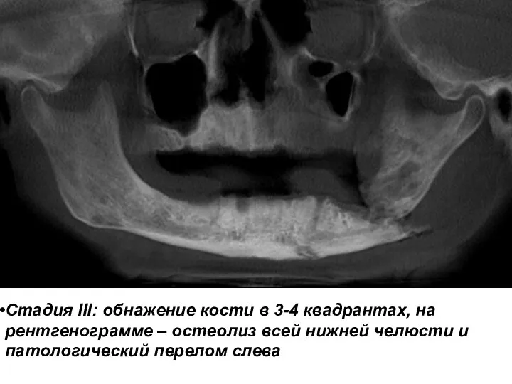 Стадия III: обнажение кости в 3-4 квадрантах, на рентгенограмме – остеолиз