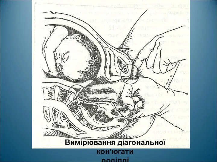 Вимірювання діагональної кон'югати роділлі