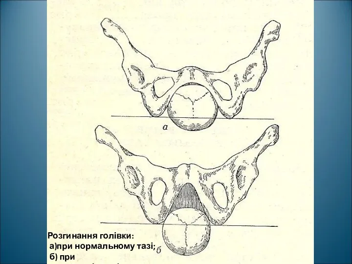 Розгинання голівки: а)при нормальному тазі; б) при загальнорівномірнозвуженому