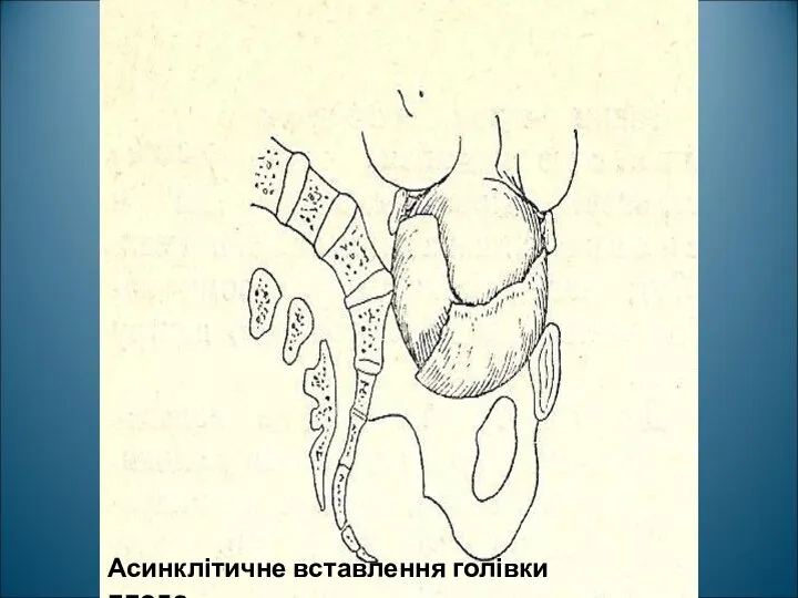 Асинклітичне вставлення голівки плода