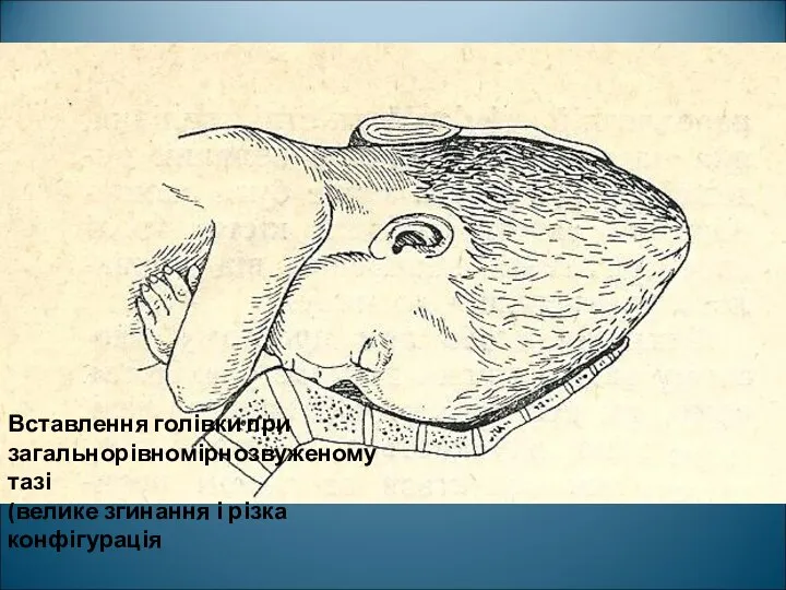 Вставлення голівки при загальнорівномірнозвуженому тазі (велике згинання і різка конфігурація
