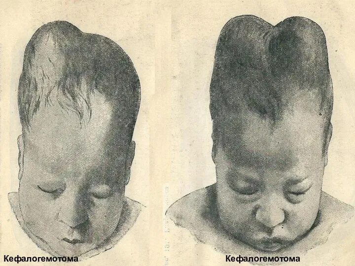 Кефалогемотома одностороння Кефалогемотома двостороння