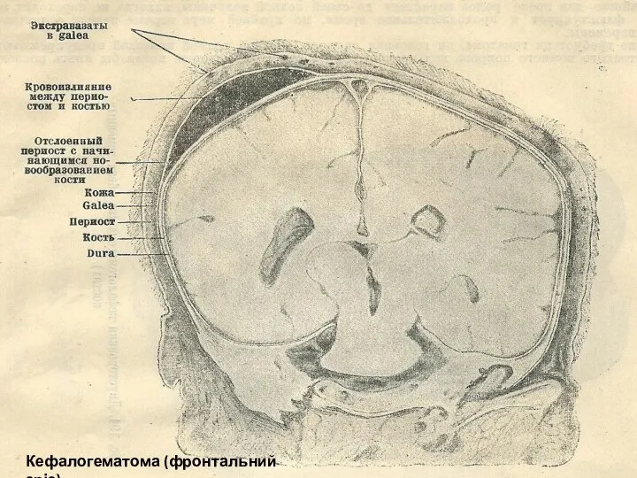 Кефалогематома (фронтальний зріз)