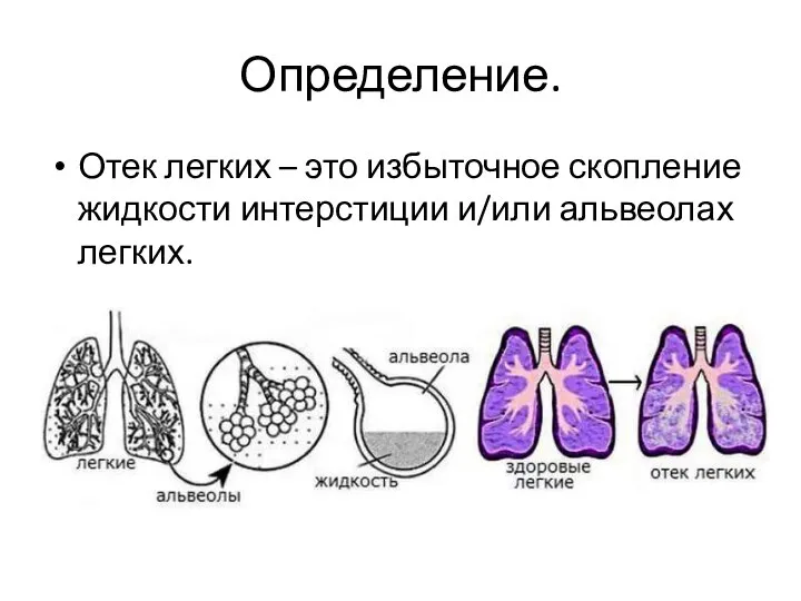 Определение. Отек легких – это избыточное скопление жидкости интерстиции и/или альвеолах легких.