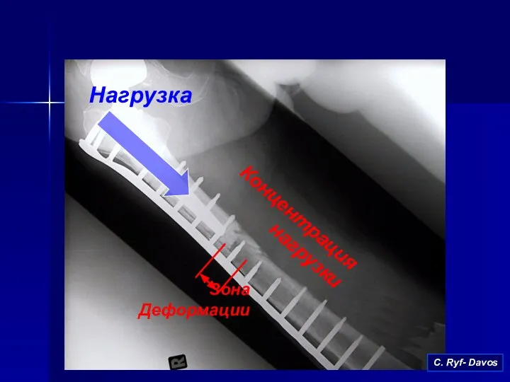 Концентрация нагрузки С. Ryf- Davos