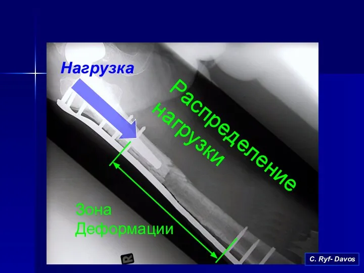 Распределение нагрузки Зона Деформации Нагрузка С. Ryf- Davos