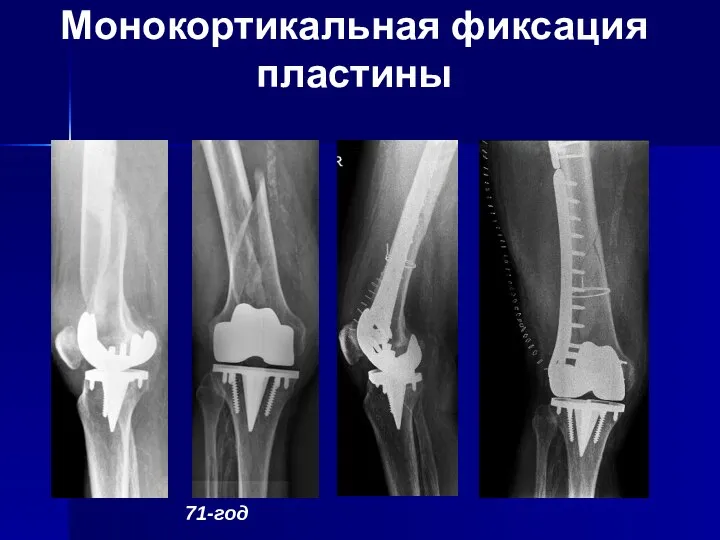 Монокортикальная фиксация пластины