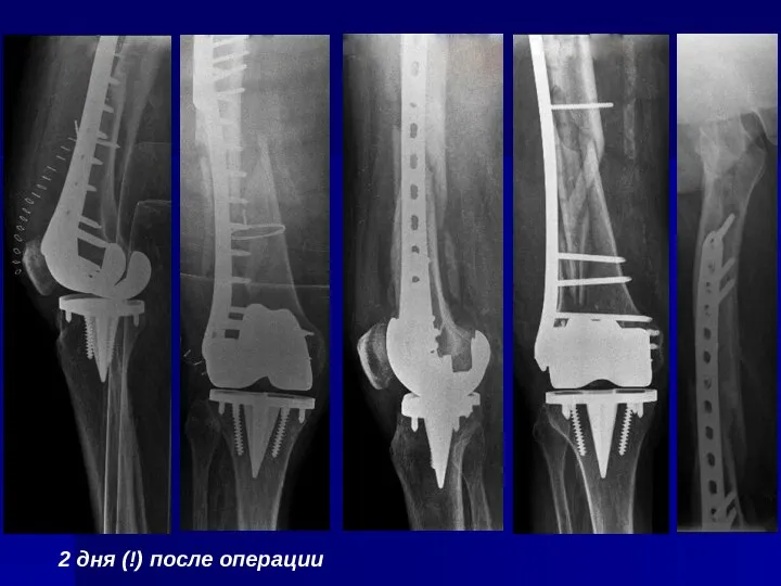 2 дня (!) после операции