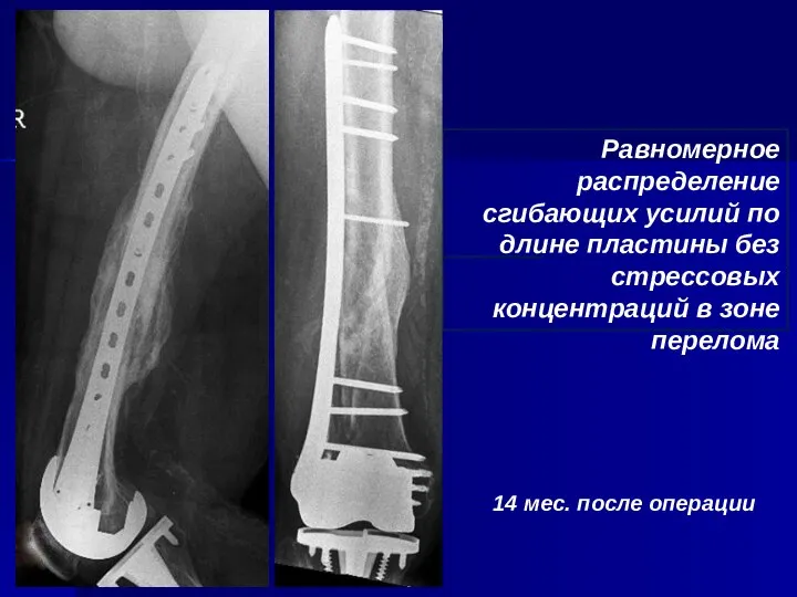 Равномерное распределение сгибающих усилий по длине пластины без стрессовых концентраций в