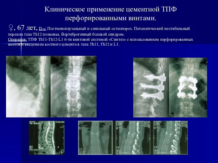 ♀, 67 лет, D-s: Постменопаузальный и сенильный остеопороз. Патологический нестабильный перелом