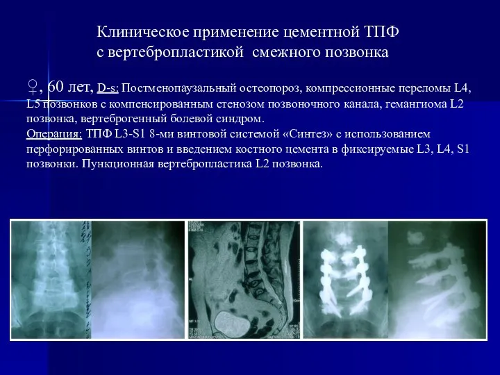 ♀, 60 лет, D-s: Постменопаузальный остеопороз, компрессионные переломы L4, L5 позвонков