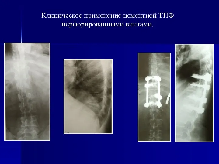 Клиническое применение цементной ТПФ перфорированными винтами.