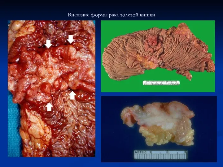 Внешние формы рака толстой кишки
