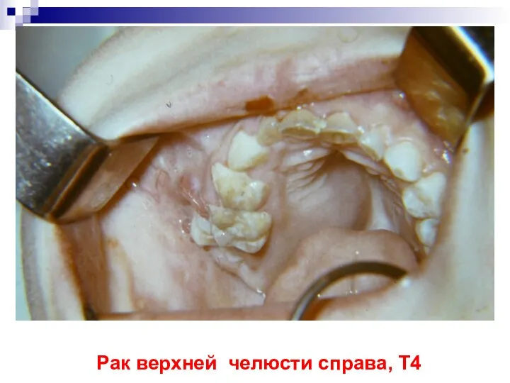 Рак верхней челюсти справа, Т4