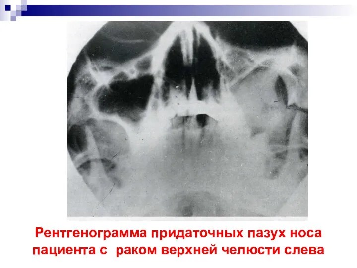 Рентгенограмма придаточных пазух носа пациента с раком верхней челюсти слева