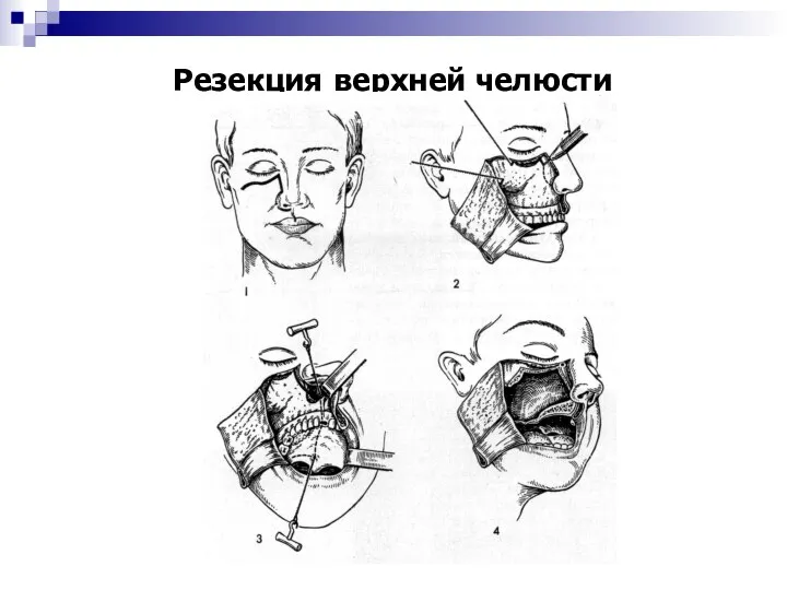 Резекция верхней челюсти