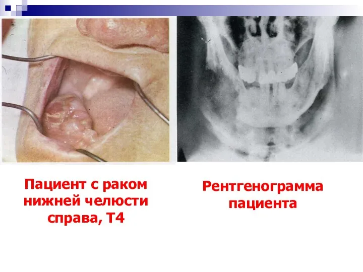 Пациент с раком нижней челюсти справа, Т4 Рентгенограмма пациента