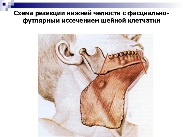 Схема резекции нижней челюсти с фасциально-футлярным иссечением шейной клетчатки