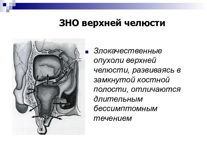 ЗНО верхней челюсти Злокачественные опухоли верхней челюсти, развиваясь в замкнутой костной полости, отличаются длительным бессимптомным течением