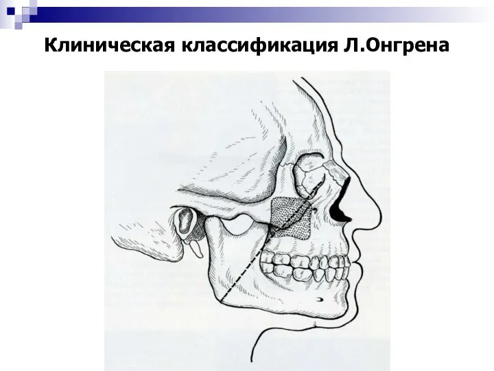 Клиническая классификация Л.Онгрена