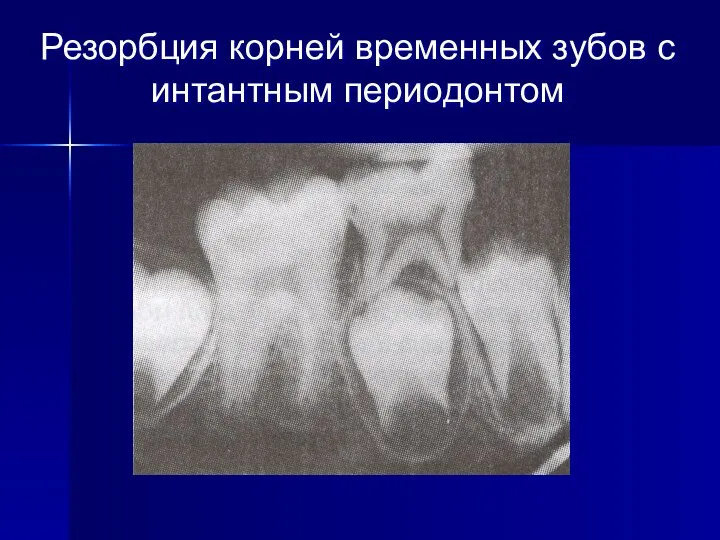 Резорбция корней временных зубов с интантным периодонтом