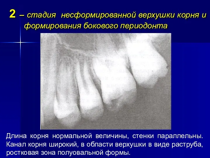2 – стадия несформированной верхушки корня и формирования бокового периодонта Длина